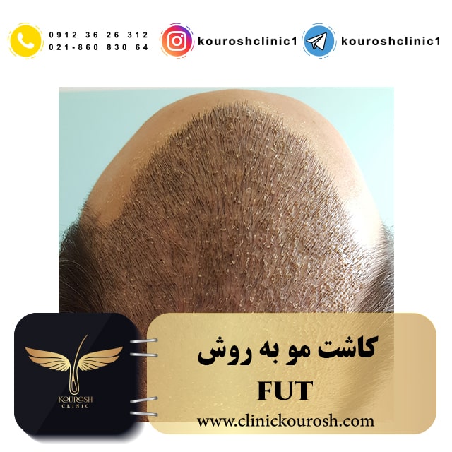 کاشت مو به روش FUT